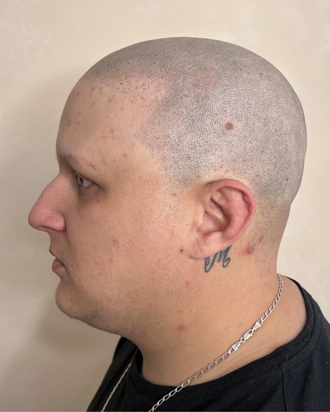 Después — Alopecia Areata tratada con micropigmentación capilar
